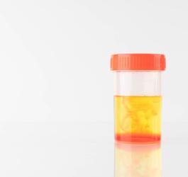 Pojemnik na mocz, w którym wyraźnie widoczna jest krew w moczu, czyli krwiomocz.