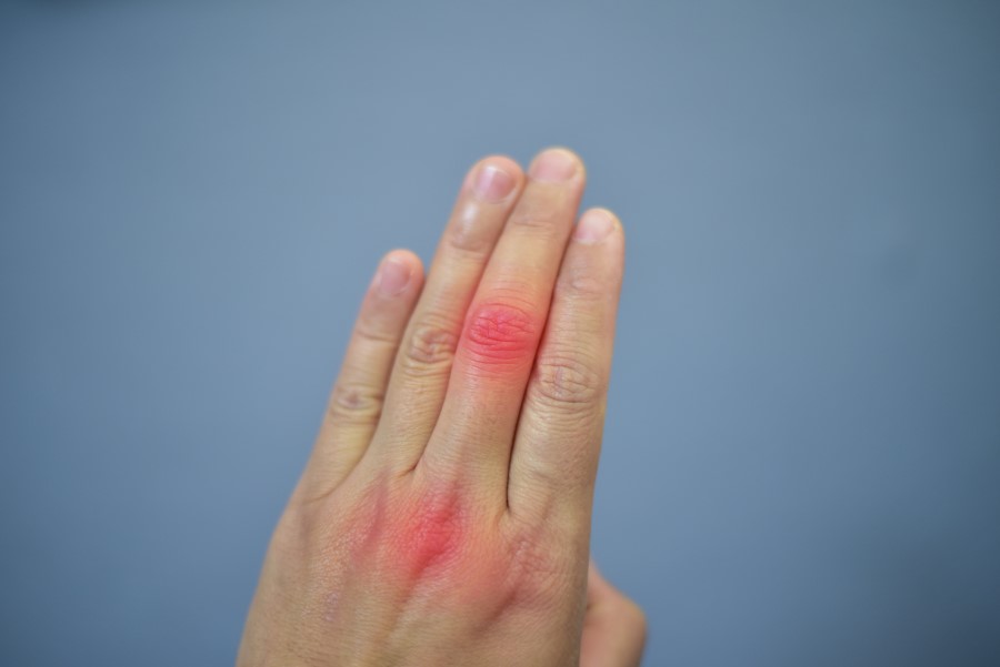 Dłoń z widocznym stanem zapalnym w stawach palców, spowodowanym nadmiarem kwasu moczowego.