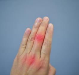 Dłoń z widocznym stanem zapalnym w stawach palców, spowodowanym nadmiarem kwasu moczowego.