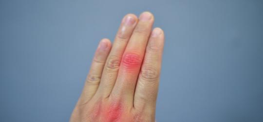 Dłoń z widocznym stanem zapalnym w stawach palców, spowodowanym nadmiarem kwasu moczowego.