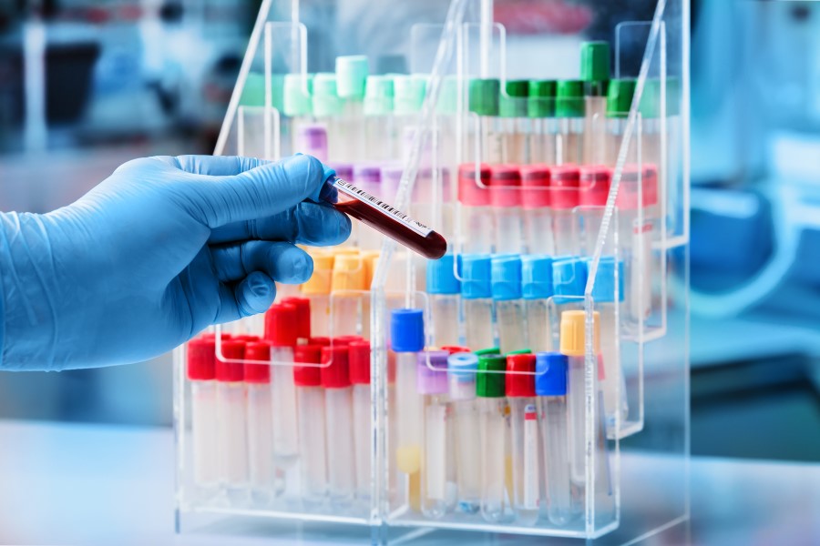 Diagnosta trzyma w ręce próbkę krwi pacjenta, przeznaczoną do badania zawartości kwasów żółciowych.