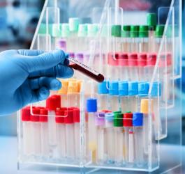 Diagnosta trzyma w ręce próbkę krwi pacjenta, przeznaczoną do badania zawartości kwasów żółciowych.