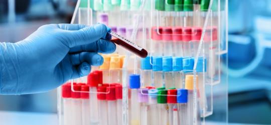 Diagnosta trzyma w ręce próbkę krwi pacjenta, przeznaczoną do badania zawartości kwasów żółciowych.