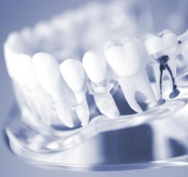 Leczenie kanałowe - na czym polega i czy jest bolesne?