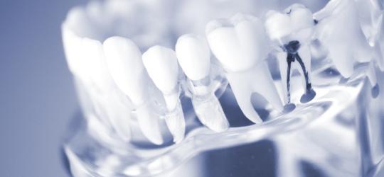 Leczenie kanałowe - na czym polega i czy jest bolesne?