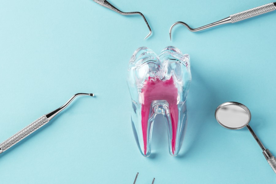 Model zęba wymagający leczenia kanałowego.