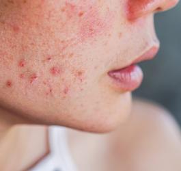 Zbliżenie na policzek kobiety z zaognionymi zmianami trądzikowymi.