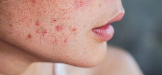 Zbliżenie na policzek kobiety z zaognionymi zmianami trądzikowymi.