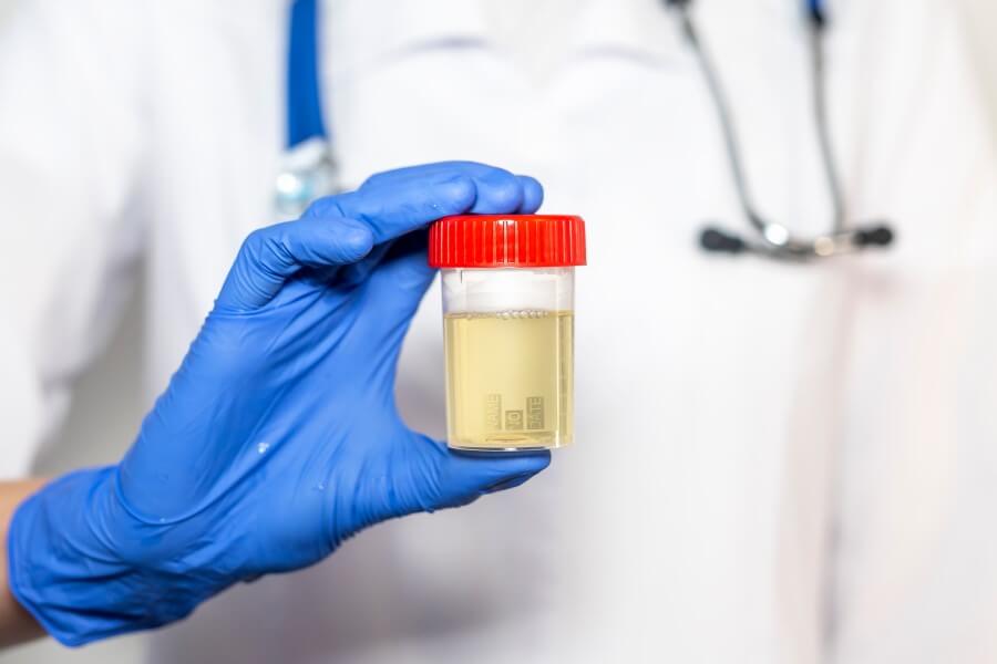 Lekarz trzyma w ręce próbkę moczu pacjenta.