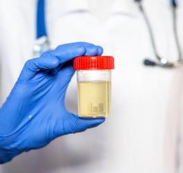 Lekarz trzyma w ręce próbkę moczu pacjenta.