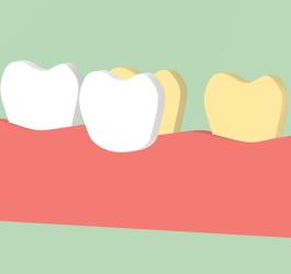 Licówki - sekret gwiazd ekranu