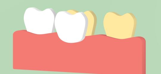 Licówki - sekret gwiazd ekranu