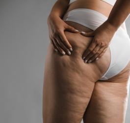 Kobieta w bieliźnie pokazuje objawy lipodemii na nogach.