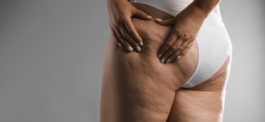 Kobieta w bieliźnie pokazuje objawy lipodemii na nogach.