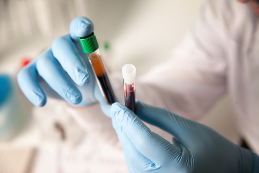Diagnosta sprawdza próbki krwi pod kątem badania lipoproteiny (A).
