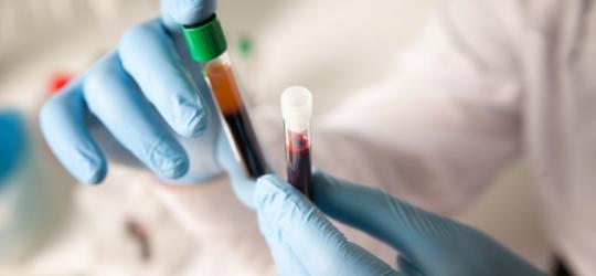 Diagnosta sprawdza próbki krwi pod kątem badania lipoproteiny (A).