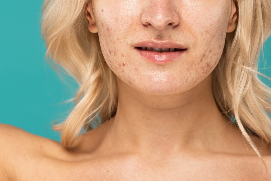 Kobieta z łojotokowym zapaleniem skóry na skórze twarzy.