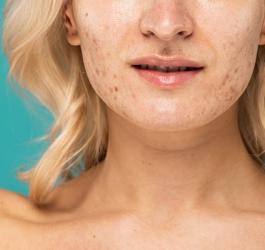 Kobieta z łojotokowym zapaleniem skóry na skórze twarzy.