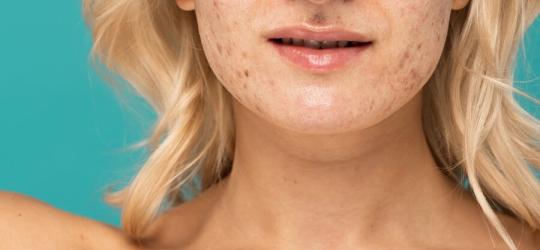 Kobieta z łojotokowym zapaleniem skóry na skórze twarzy.