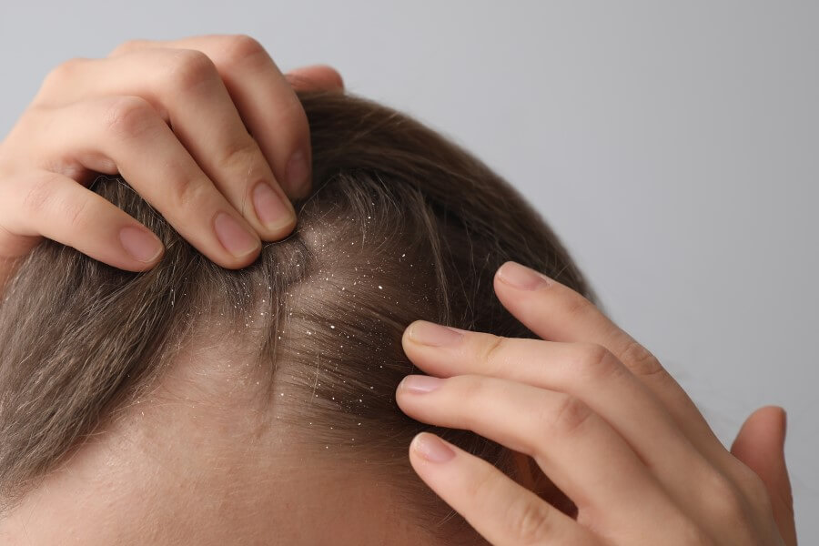Kobieta rozdziela włosy na głowie, na których widać łupież.