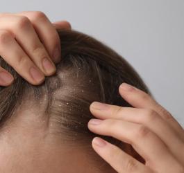 Kobieta rozdziela włosy na głowie, na których widać łupież.