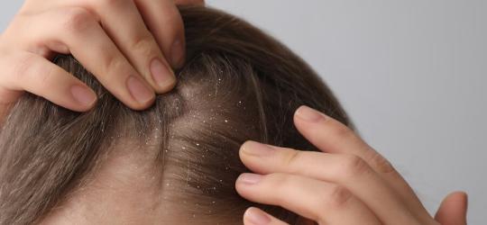 Kobieta rozdziela włosy na głowie, na których widać łupież.
