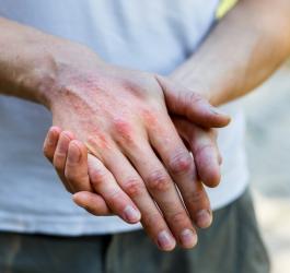 Łuszczyca - czy można ją wyleczyć?