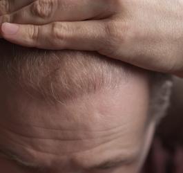 Mężczyzna pokazuje skutki łysienia androgenowego na swojej głowie.