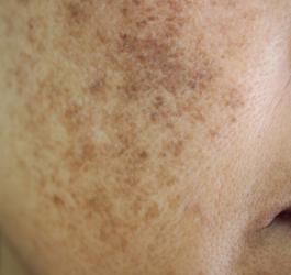 Zbliżenie na skórę kobiety z widoczną melasmą.