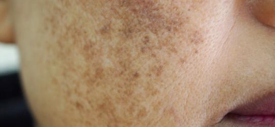 Zbliżenie na skórę kobiety z widoczną melasmą.