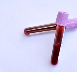 Próbki krwi w fiolkach przeznaczone do badania poziomu mioglobiny.