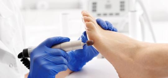 Podolog usuwa modzele ze stopy kobiety.