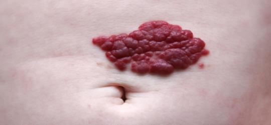 Naczyniak - co to jest?