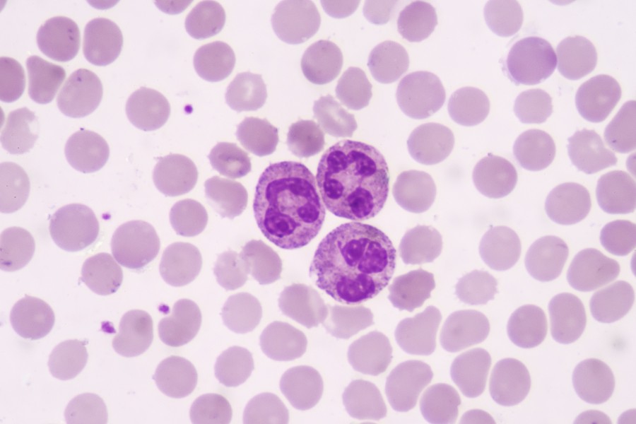 Neutrofile poniżej normy. Jakie są przyczyny?