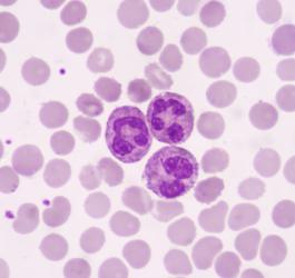 Neutrofile poniżej normy. Jakie są przyczyny?