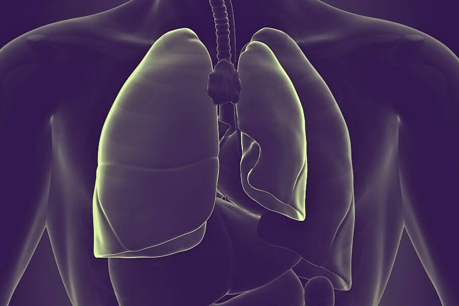 Płuca człowieka z widoczną odmą opłucnową.