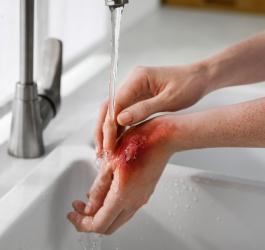 Kobieta po oparzeniu wrzątkiem oblewa rękę pod bieżącą wodą.