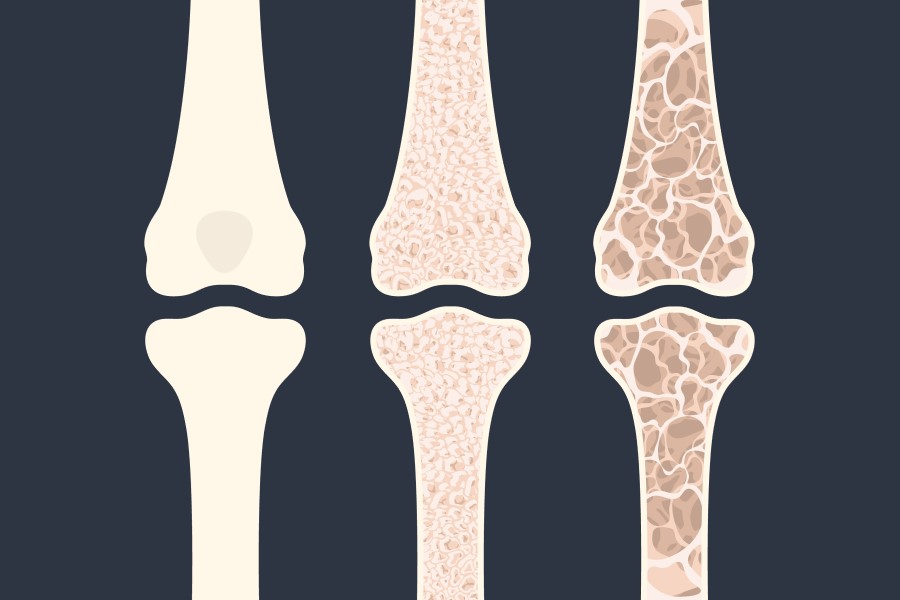 Schemat utraty gęstości kości w przebiegu osteopenii i osteoporozy.