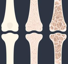 Schemat utraty gęstości kości w przebiegu osteopenii i osteoporozy.