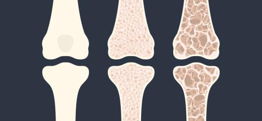 Schemat utraty gęstości kości w przebiegu osteopenii i osteoporozy.