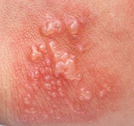 Zbliżenie na skórę z widocznym zaczerwienieniem i pęcherzami.