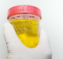 Diagnosta trzyma w ręce pojemnik z próbką pieniącego się moczu.