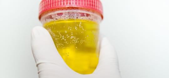 Diagnosta trzyma w ręce pojemnik z próbką pieniącego się moczu.