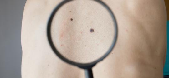 Pieprzyki - czy mogą być groźne?