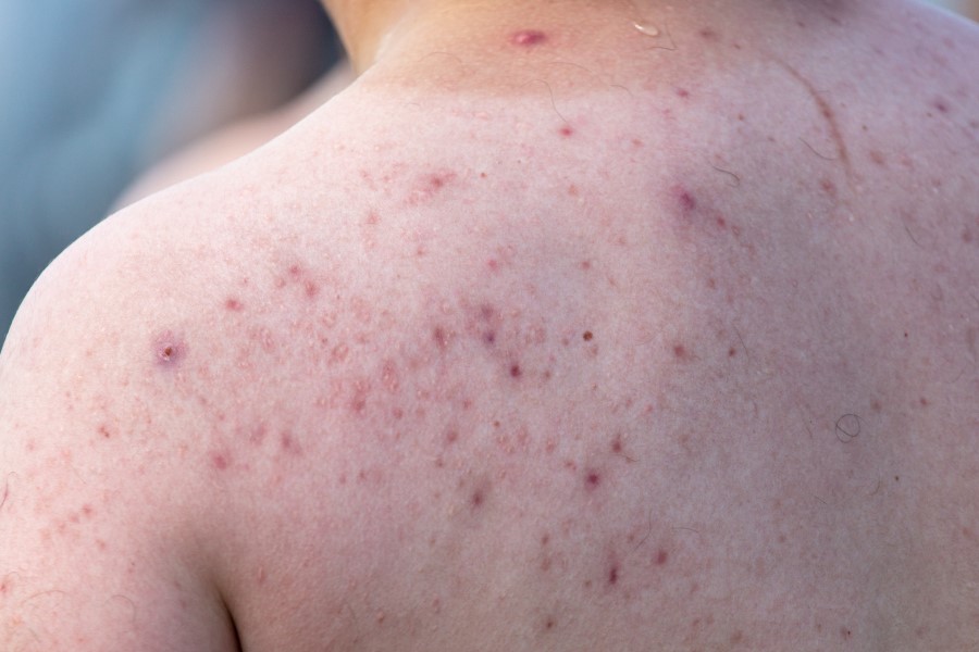 Zbliżenie na skórę pleców z widocznymi, czerwonymi plamami.