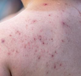 Zbliżenie na skórę pleców z widocznymi, czerwonymi plamami.