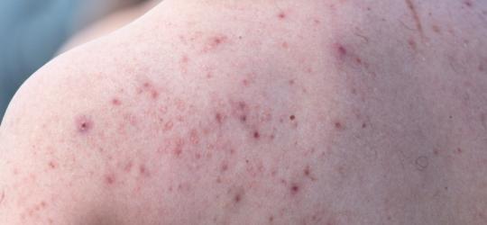 Zbliżenie na skórę pleców z widocznymi, czerwonymi plamami.