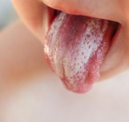 Pleśniawki na języku małego dziecka.