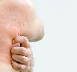 Mężczyzna drapie się po tułowiu i plecach, ma na skórze pokrzywkę alergiczną.