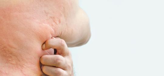 Mężczyzna drapie się po tułowiu i plecach, ma na skórze pokrzywkę alergiczną.